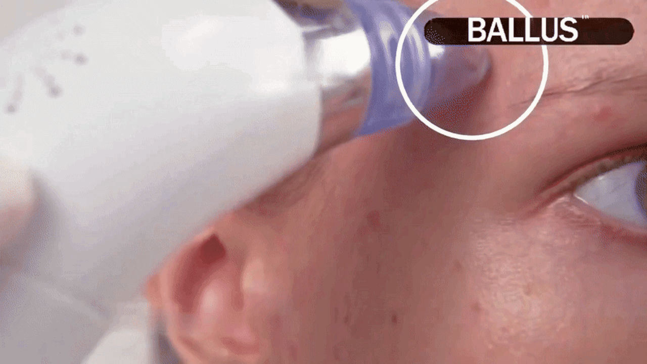PoreVac Pro – Deep Pore Cleansing & Blackhead Remover